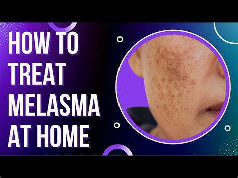 Melasma: Causes, Symptoms, and Treatment | SchoolTube