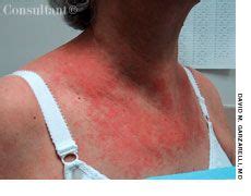 Lymphoma Rash / Armpit Rash Lymphoma : Skin rashes are uncommon ...