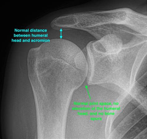 Shoulder Arthritis and Replacement | Orthopedic Centers of Colorado