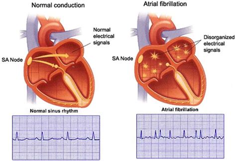 Pin on Atrial Fibrillation Treatment