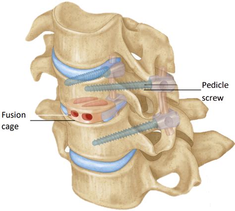 Back Pain Treatment - CESS - Center of excellence in spine surgery