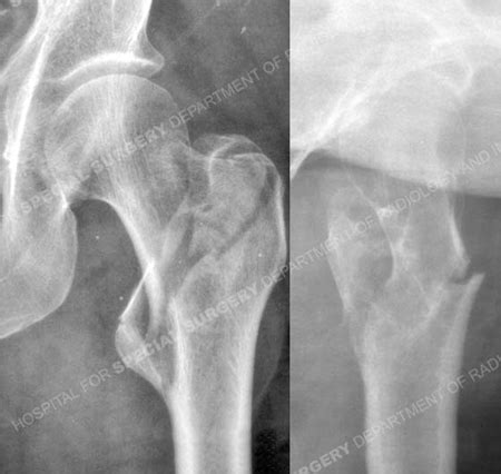 Hip Fracture