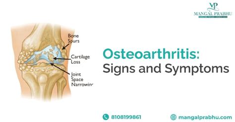 Osteoarthritis Signs and Symptoms