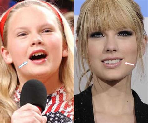 Did Taylor Swift Get Plastic Surgery? (Before & After Photos)