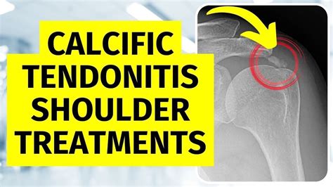 Calcific Tendonitis Shoulder Treatments Without Surgery - YouTube