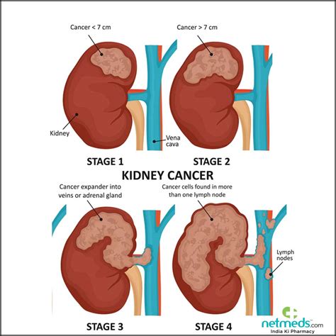 Kidney Cancer