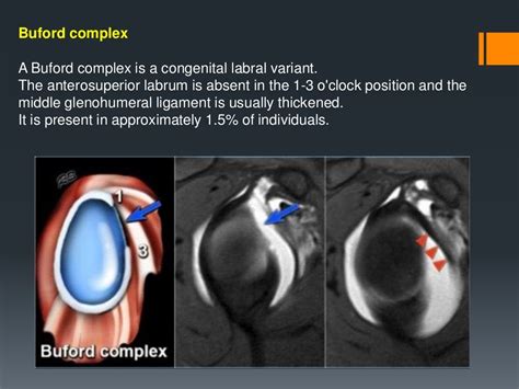 Shoulder labral tears MRI