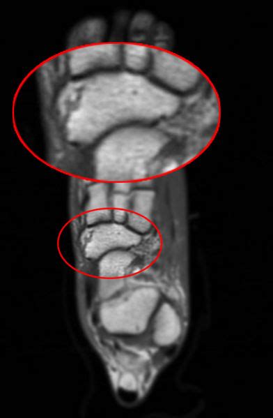 Navicular fracture - wikidoc