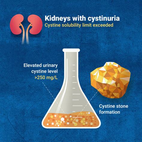 Cystine Kidney Stones