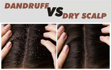 Differences between Dandruff and dry scalp [Explained] - Medical Darpan