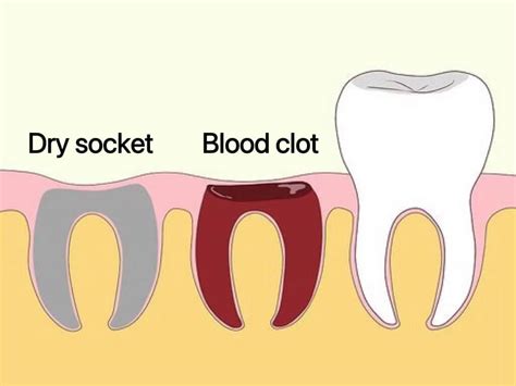 Can I Vape After Wisdom Tooth Removal