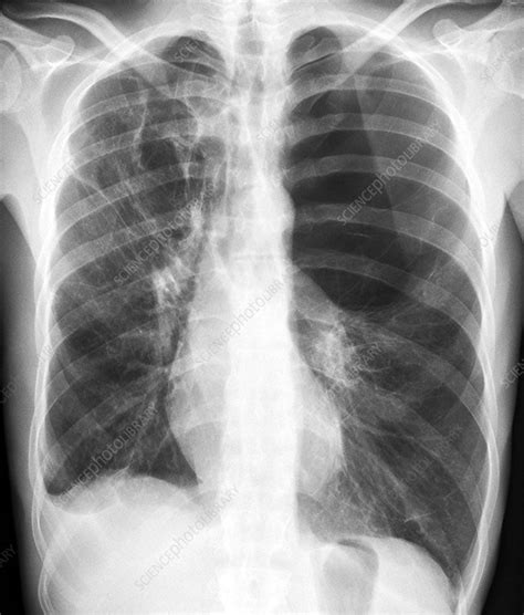 Pulmonary emphysema, X-ray - Stock Image - C021/2973 - Science Photo ...