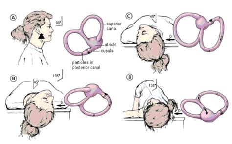 Epley Maneuver - Exercises for Vertigo - ENT Clinic