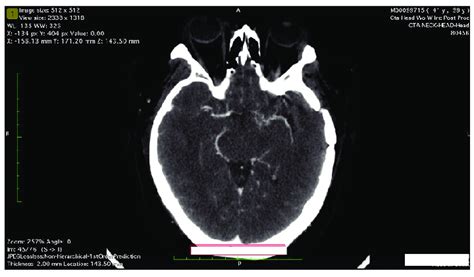 Axial view of CT Angiogram of the head at the level of the Circle of ...