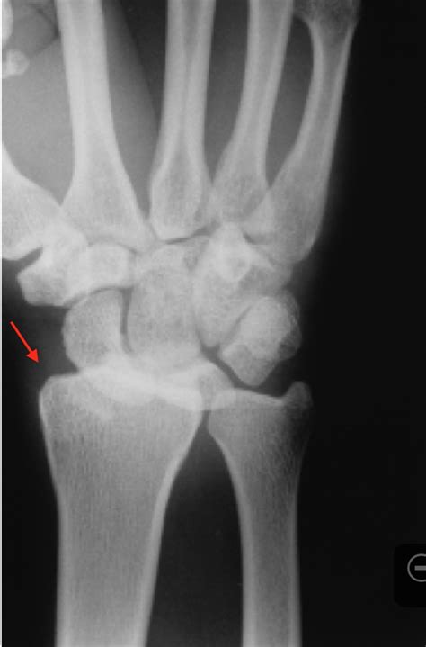 Radiocarpal Fracture Dislocation - Hand - Orthobullets