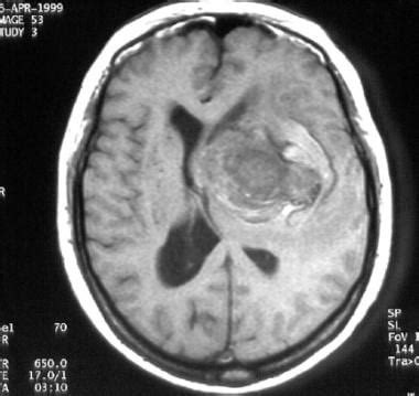 Cerebral Aneurysm Angiogram