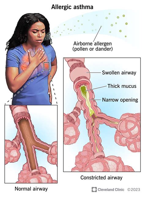 Asthma Rash Eos Level Severe Tingling Online | varsana.com