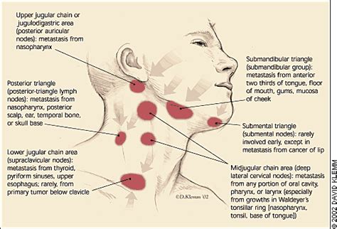 Enlarged Lymph Nodes In Neck