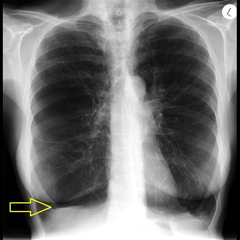 Pulmonary Emphysema X Ray