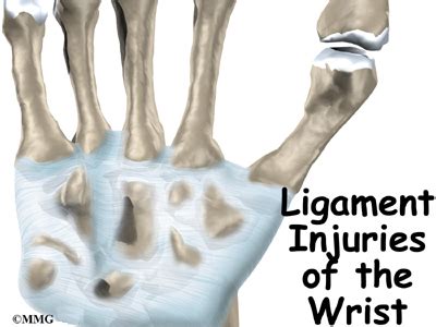 Ligament Injuries of the Wrist - Orthopedic Surgery, Algonquin, IL ...