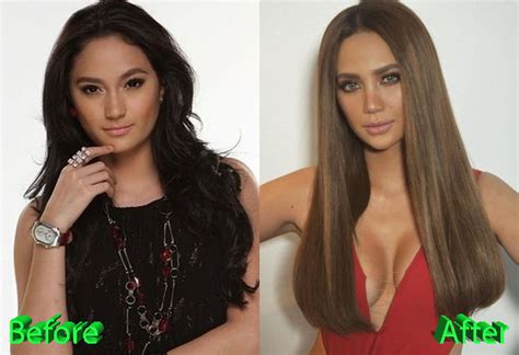 Arci Munoz Before and After Cosmetic Surgery