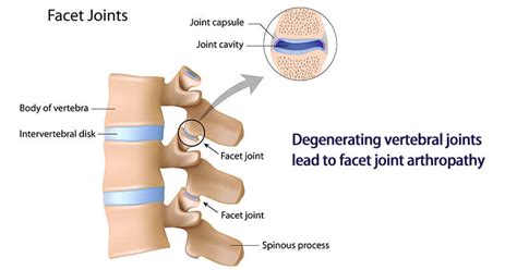 Facet Joint Arthropathy: Symptoms Causes Prevention and Treatment