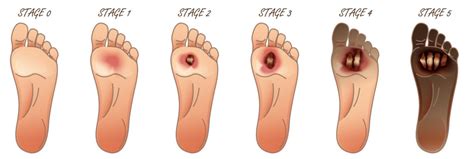 Staph Infection on the Toe or Foot [Early Signs & BEST Treatment]