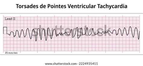 Ecg Torsades De Pointes Ventricular Tachycardia เวกเตอรสตอก ปลอดคา