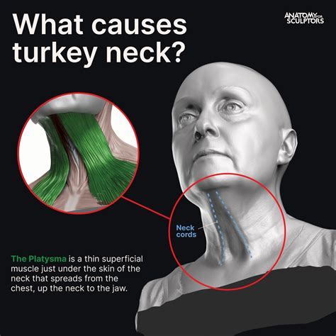 Anatomy For Sculptors - What causes turkey neck?