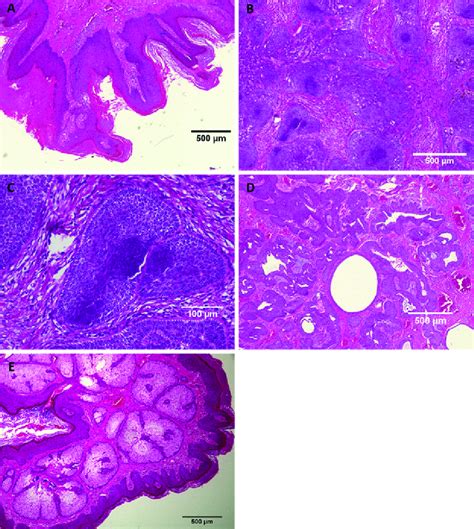 Figure3.Histology of the lesions. (A) Histology of the epidermal nevus ...