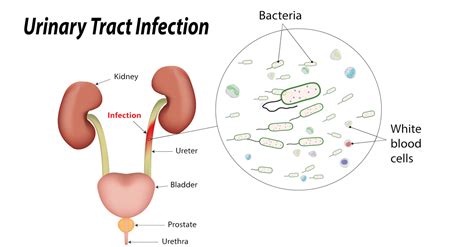 Pyuria - Drugs Details