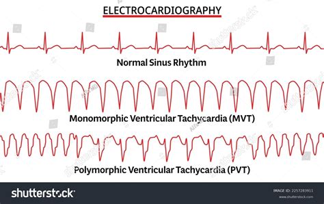 Set Ecg Common Abnormalities Normal Sinus Stock Vector Royalty Free