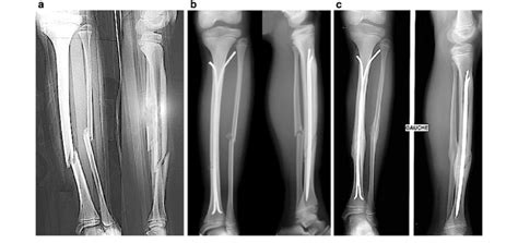 Tibia fracture treated by ESIN, a displaced shaft fracture of fibula ...