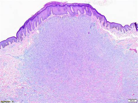 Dermatofibroma Histology