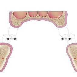 (PDF) An Interarch Alveolar Ridge Relationship Classification