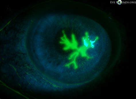 Herpes simplex virus (HSV) geographic epithelial keratitis