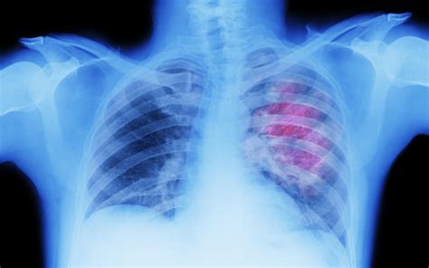 Mediastinal Lymphadenopathy