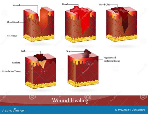 Wound healing stock vector. Illustration of brown, cross - 19023103