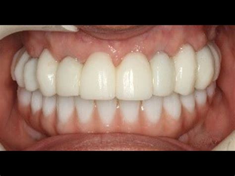 Implant Bridges: What is the process? - Dental Implant Center