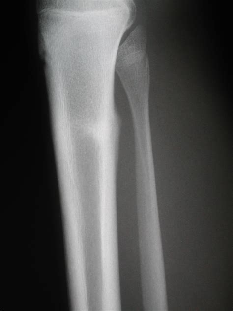 Stress Fracture X Ray Tibia