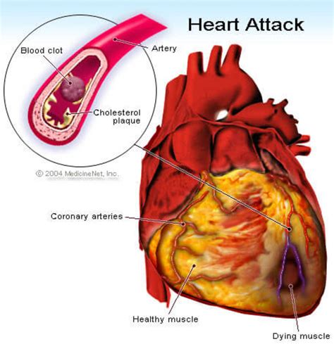 ♥ How to Beat Your Atrial Fibrillation ♥ An Introduction to A-Fib ...