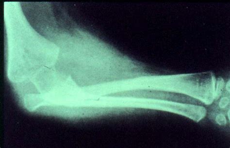 Congenital Radial Head Dislocation - Hand - Orthobullets