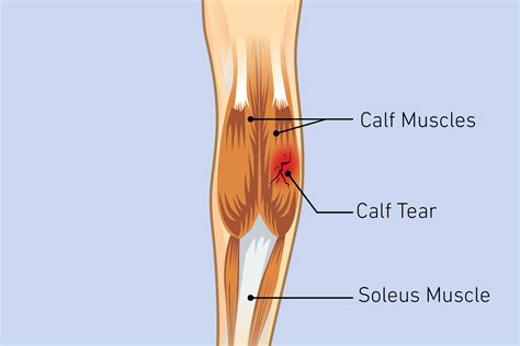 Calf Pain: Causes, Diagnosis, and Treatment | The Healthy