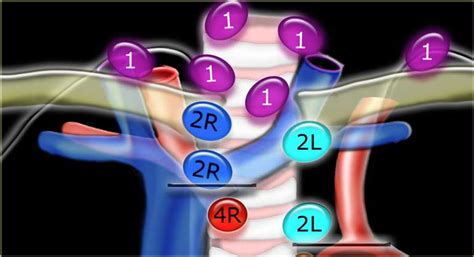 The Radiology Assistant : Mediastinal Lymph Node Map (2023)