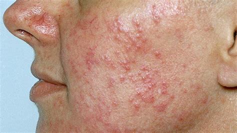 All Rosacea Articles