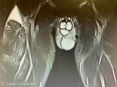 Rectus femoris injury information - Urheiluortopedi Lasse Lempainen