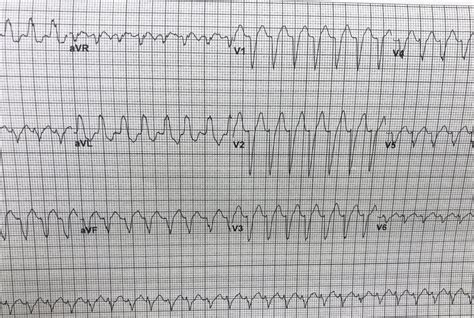 Dr Smiths Ecg Blog Ventricular Tachycardia Or Svt With Aberrancy