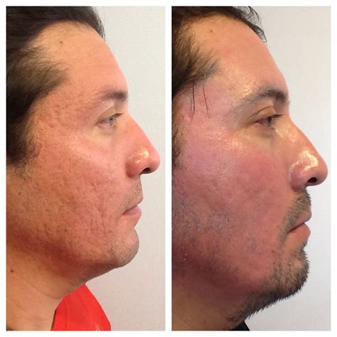 Fractional CO2 Laser Rental to Treat Ance Scars and Sun Damage ...