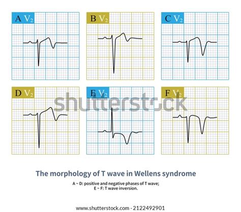 Wellens Syndrome Can Be Divided Into Stock Illustration 2122492901 ...