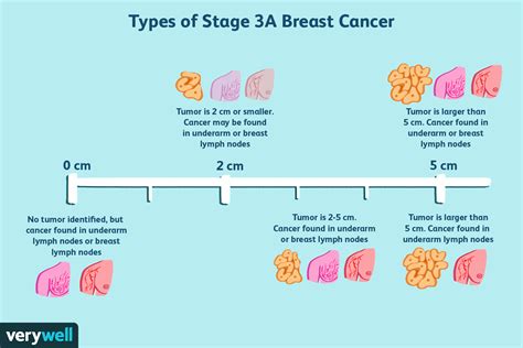 Stage 3 Breast Cancer: Types, Treatment, Survival